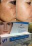 Best Cream Anti Melasma Reduce…